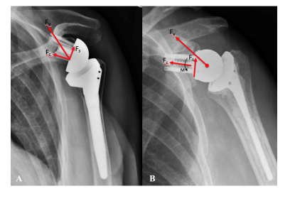 Figure 2. A. Reverse shoulder arthroplasty (RSA) acting with a fixed CoR with compressive (Fc) and shear (Fs) components of the resultant force vector (Fv). B. CoR lateralization increases the lever arm length which decreases compressive forces, increases destabilizing shear forces, and creates a new moment (M) at the glenoid-implant interface [34]. RSA: Reverse Shoulder Arthroplasty; CoR: Center of Rotation.